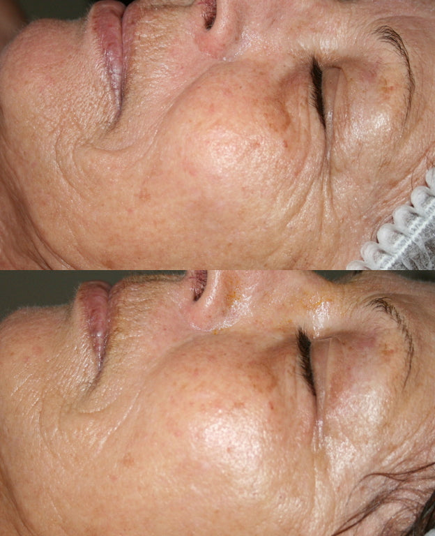 The Visual Characteristics of Diminished Collagen and Elastin