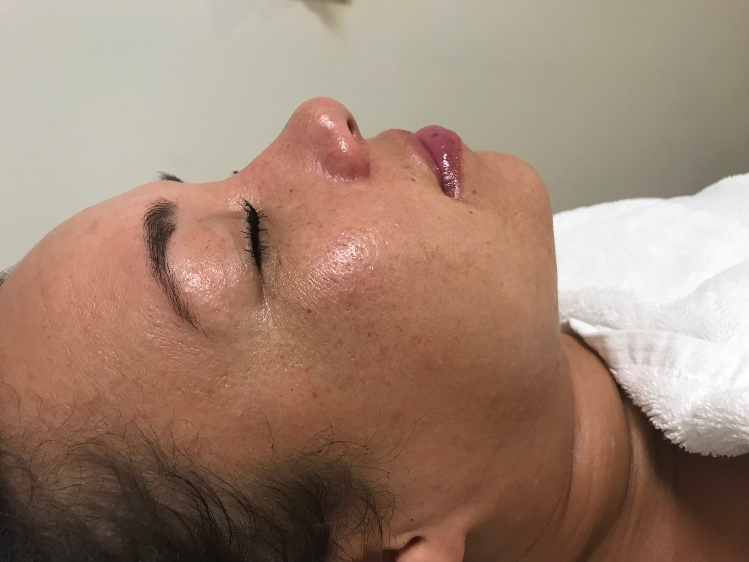 B treatment Series // #3 Before and After Qi beauty Facial Treatment