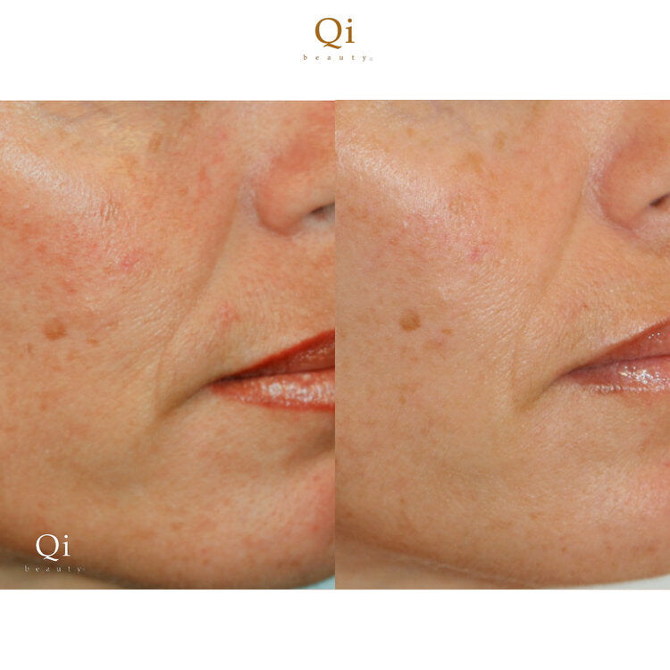 Qi beauty™ Home Kit – Complete STIMs Edition